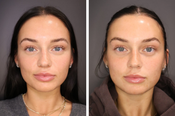 Botox (3) Botox (3)