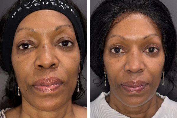 Cheek filler (2) Cheek filler (2)