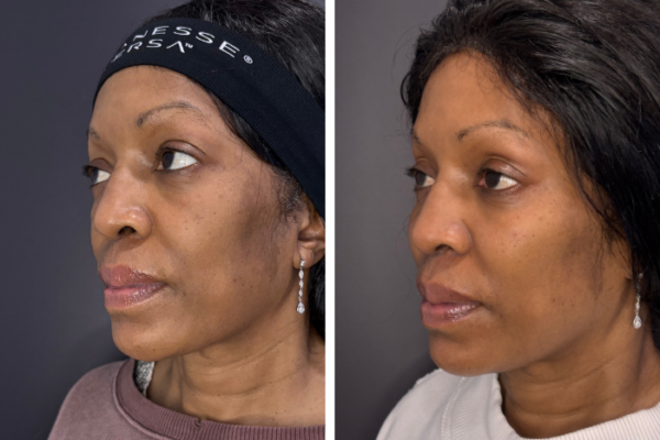 Cheek filler (3) Cheek filler (3)