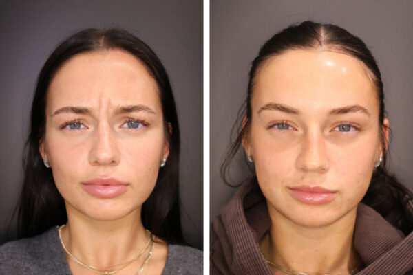 botox botox